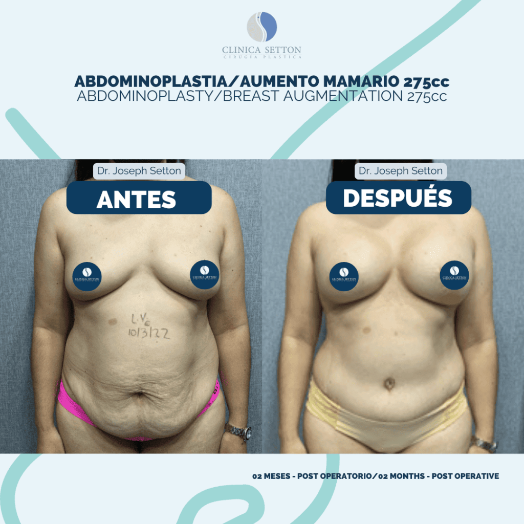 Mommy Makeover Dr Joseph Setton. Cirujano Plástico en Panamá (1)