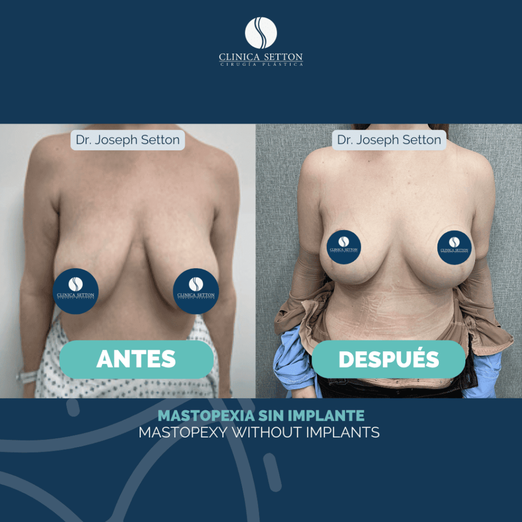 Mommy Makeover Dr Joseph Setton. Cirujano Plástico en Panamá (2)