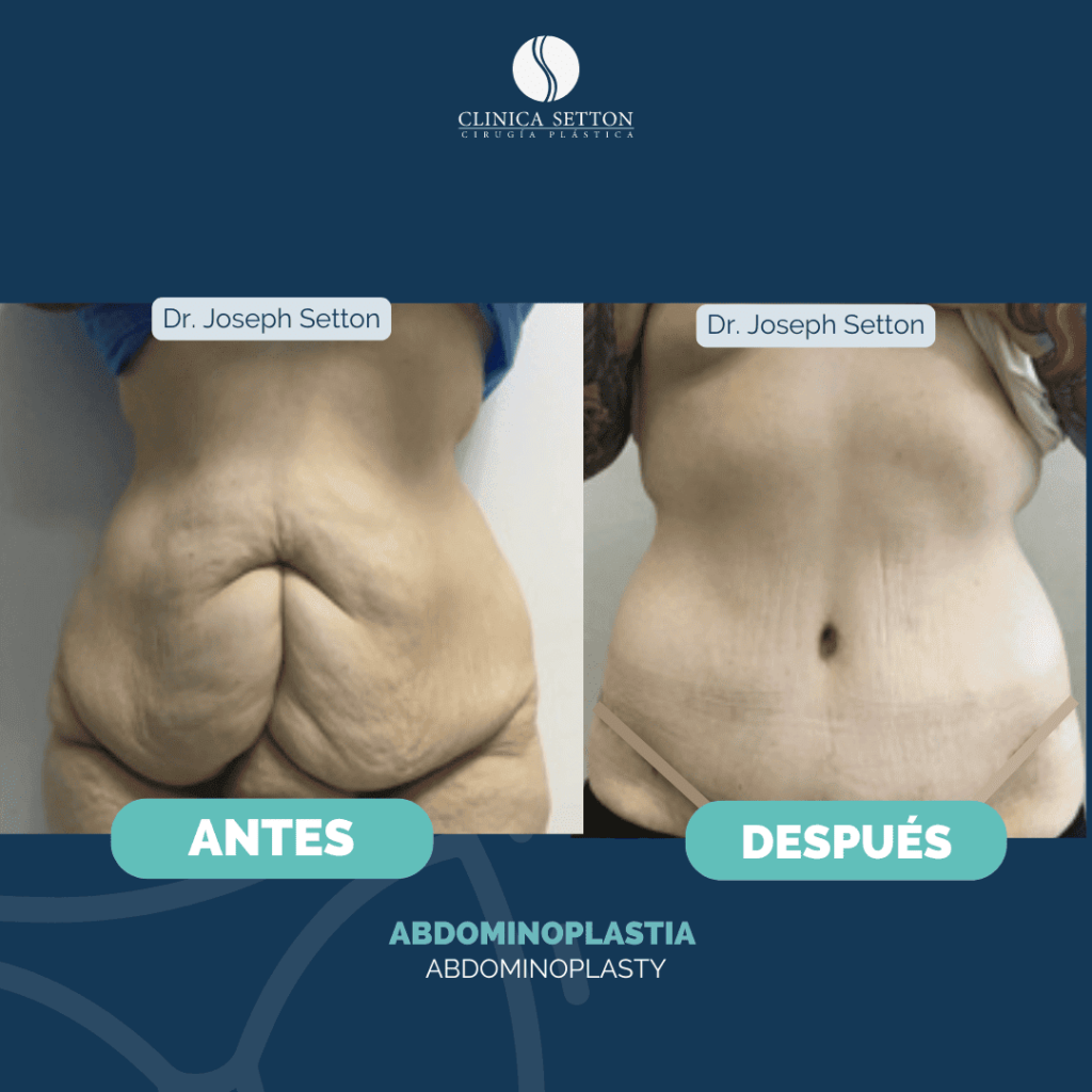 Mommy Makeover Dr Joseph Setton. Cirujano Plástico en Panamá (3)