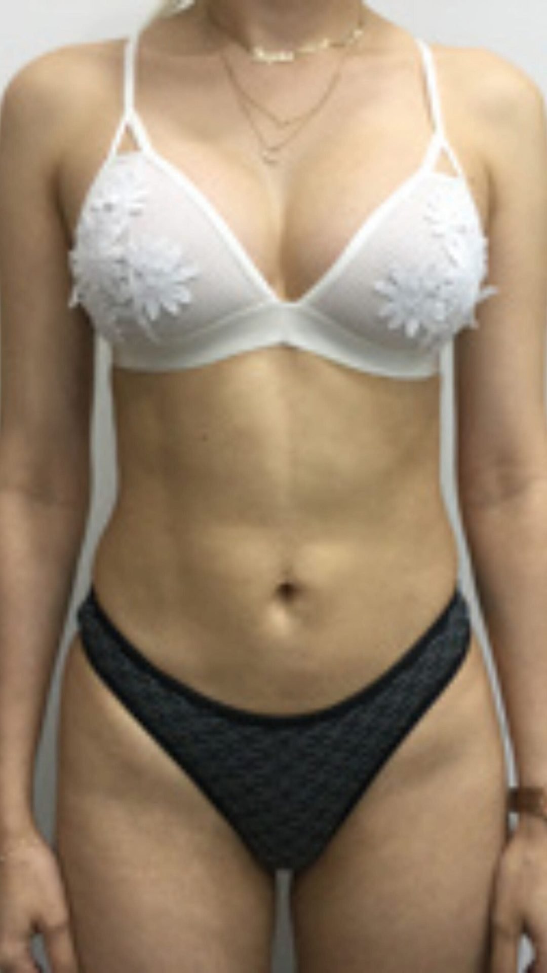 Mommy Makeover Dr Joseph Setton. Cirujano Plastico en Panamá (4)